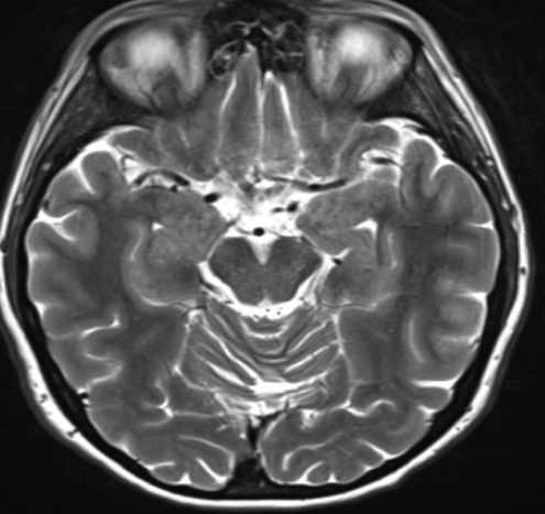 Brain MRI FLAIR Axial - Normal