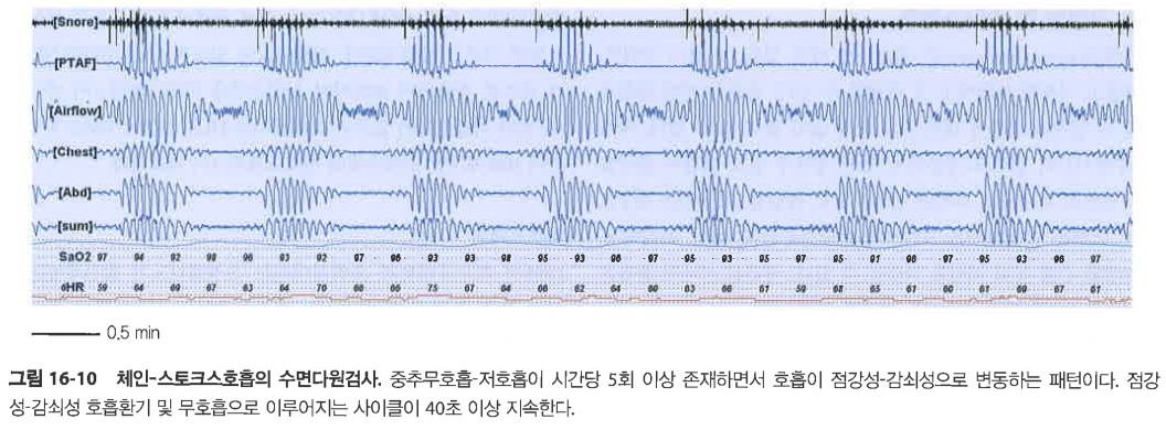 Cheyne-Stokes 호흡 양상을 보이는 수면다원검사(PSG) 에포크. 복부와 흉부의 호흡 노력이 점진적으로 증가했다가 감소하는 다이아몬드 형태의 중추성 무호흡 양상이 특징적임.