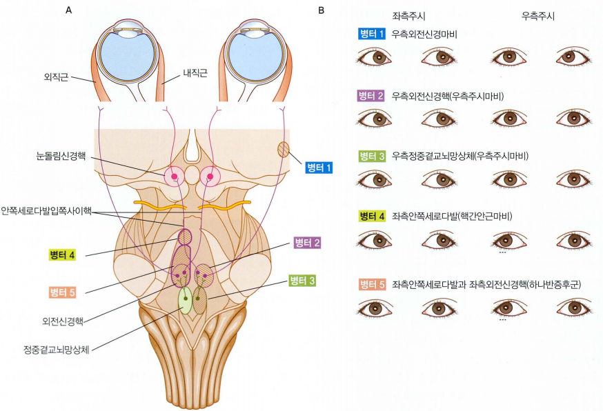핵간안근마비(INO)의 기전 및 신경 경로 모식도
