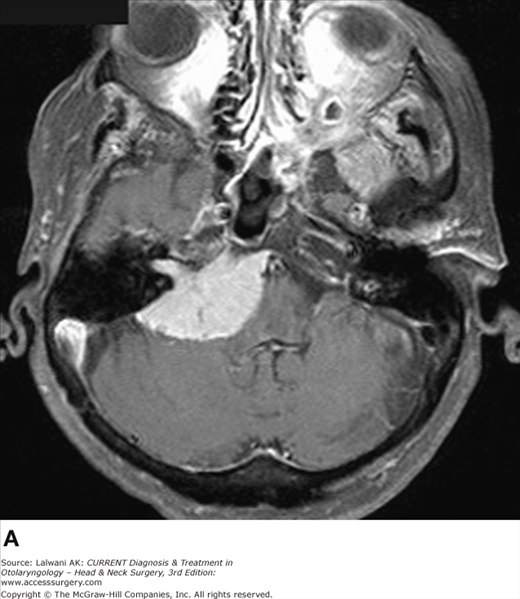 CPA Tumor MRI