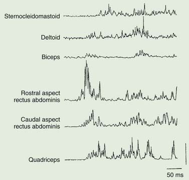 Surface EMG showing long-duration muscle bursts starting in the rectus abdominis and propagating rostrally and caudally.