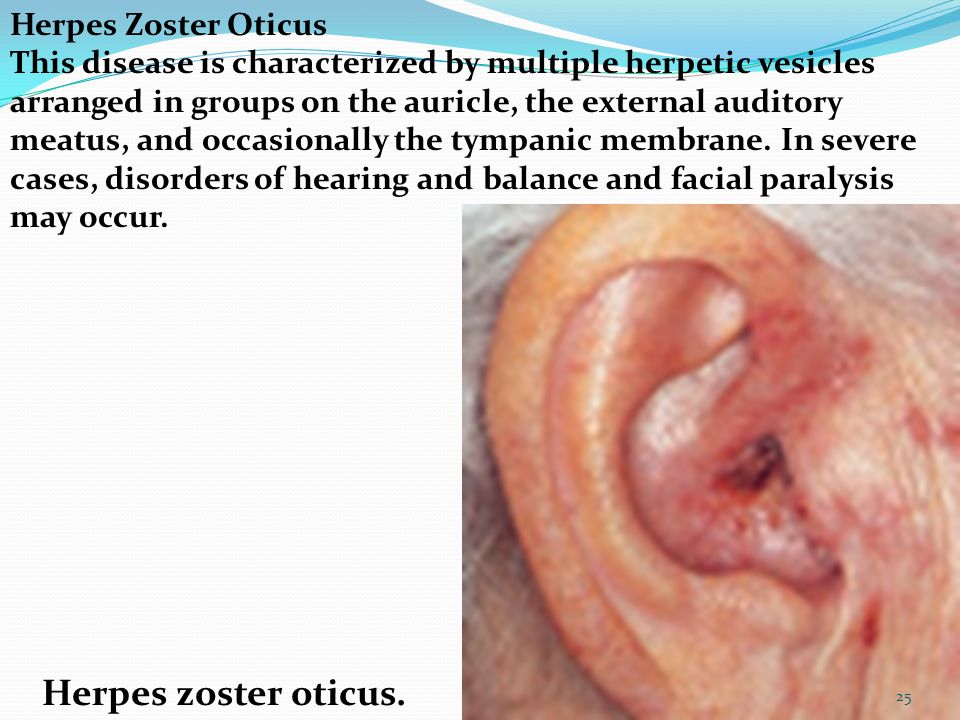 외이개(Auricle) 부위에 다발성의 홍반성 수포가 관찰되는 사진