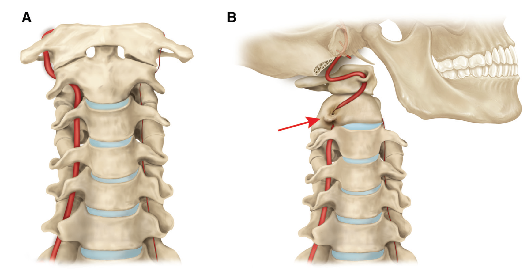 Mechanism of Bow Hunter's Syndrome