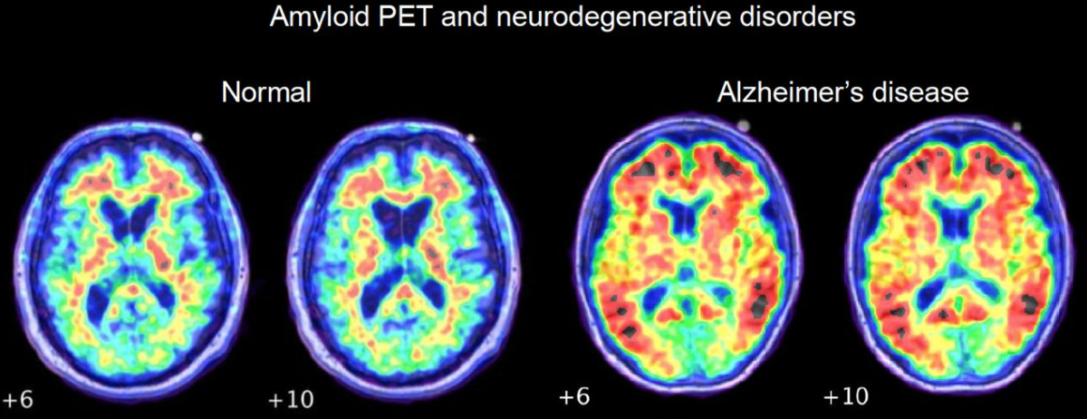 Comparison of Amyloid PET negative vs positive scans