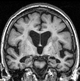 T1-weighted coronal MRI showing bilateral hippocampal atrophy