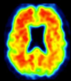 Amyloid PET axial view 2 showing loss of gray-white matter contrast