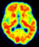 Amyloid PET axial view 3 showing diffuse tracer retention