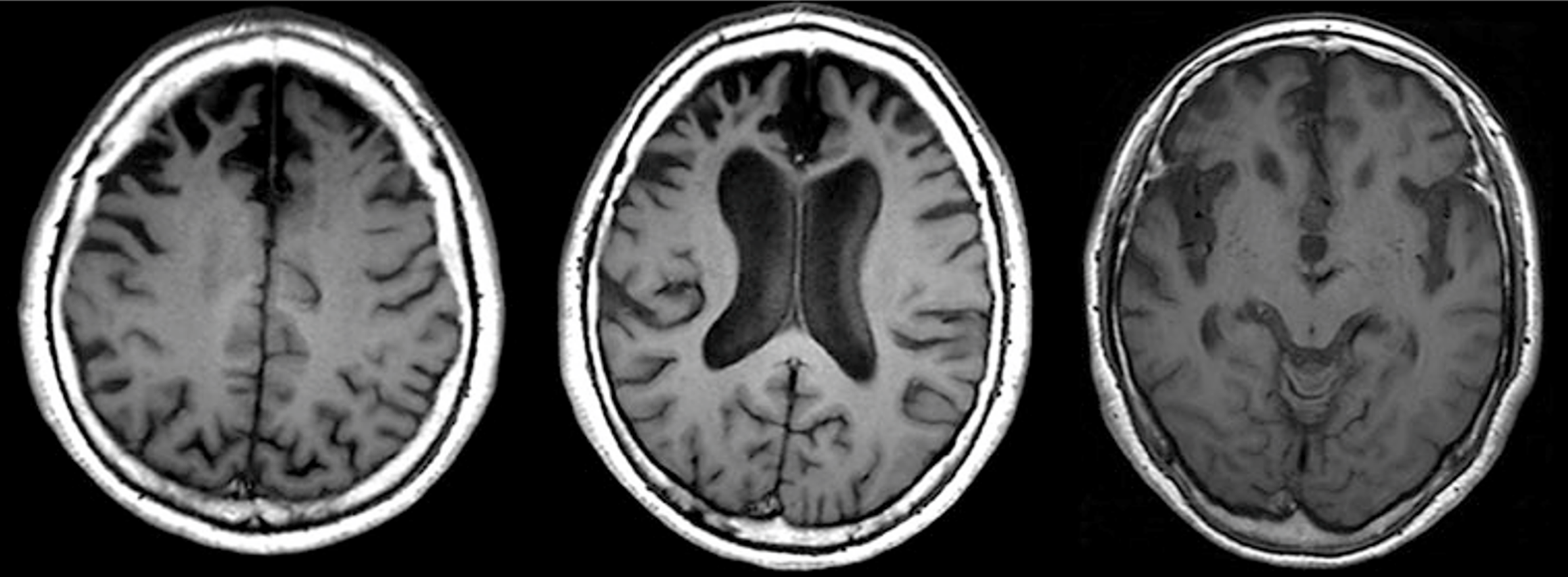 MRI T1-weighted axial/coronal images showing prominent bilateral prefrontal atrophy and widening of frontal sulci.