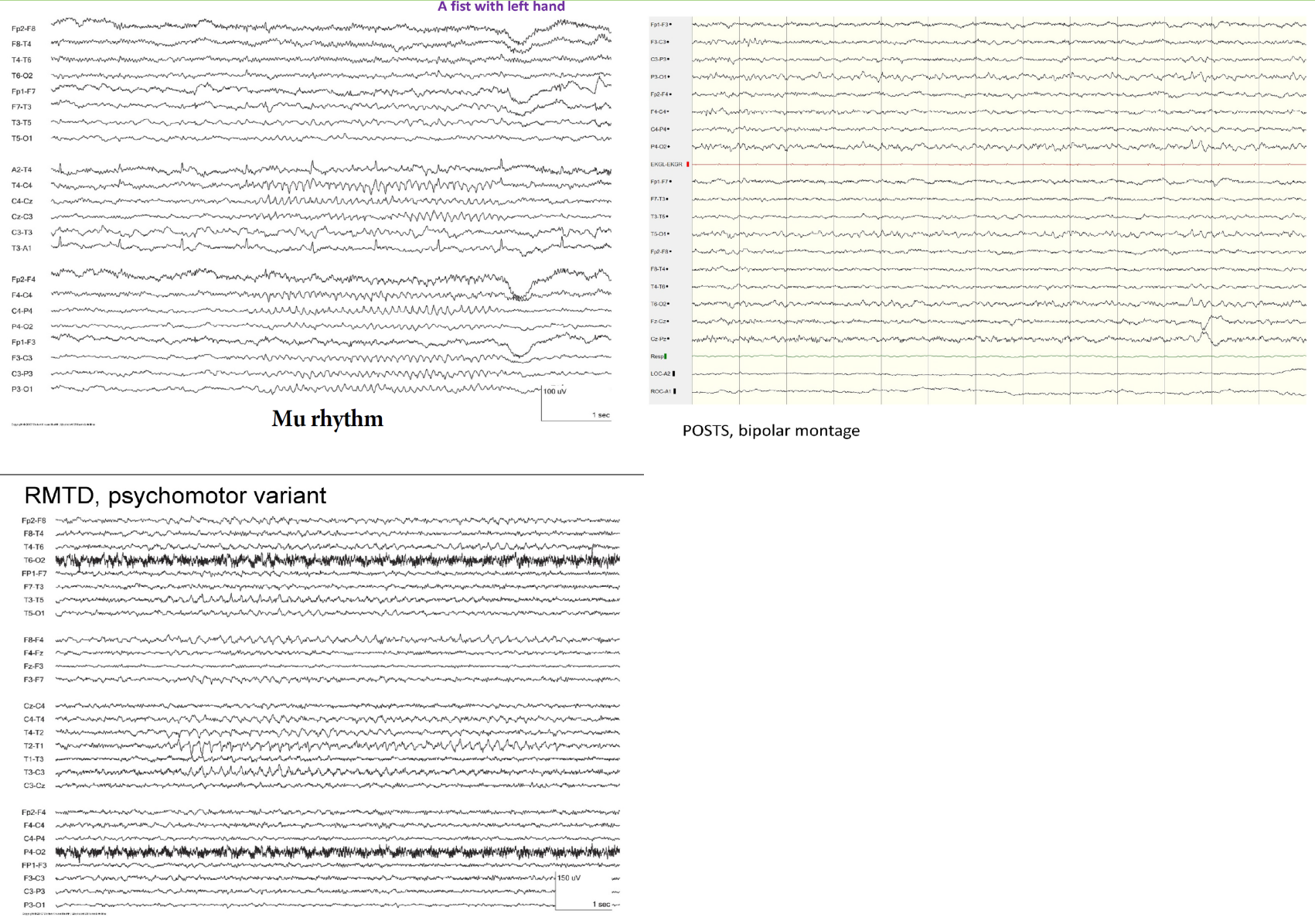 뇌파 분석 예시. Vertex sharp transient, Sleep spindle, POSTs 등이 각각 화살표와 텍스트로 라벨링되어 있는 교육용 뇌파 이미지.