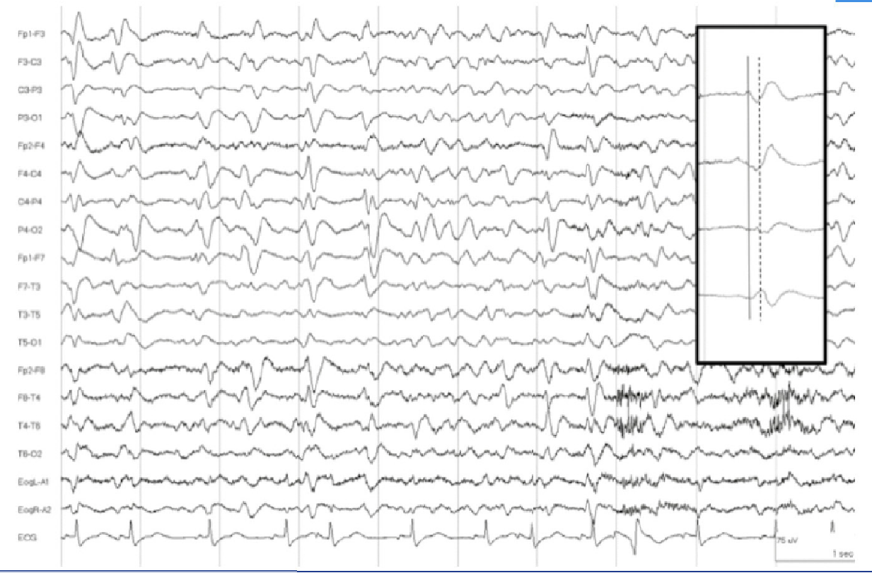 EEG showing triphasic waves