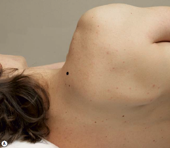 그림 1: 등세모근(Trapezius) 부위에 점이 표시된 인체 후면도