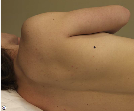 그림 4: 넓은등근(Latissimus dorsi) 부위에 점이 표시된 인체 후면도