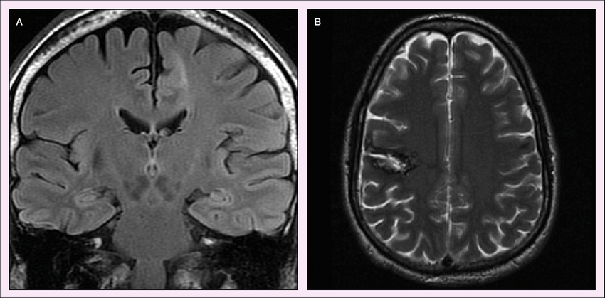 Brain MRI Schematic
