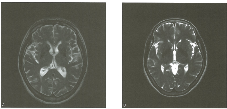 뇌 MRI T2 강조영상 축상면(axial view). 조가비핵(putamen) 외측 경계에 선형의 고신호강도(putaminal slit)가 관찰됨.
