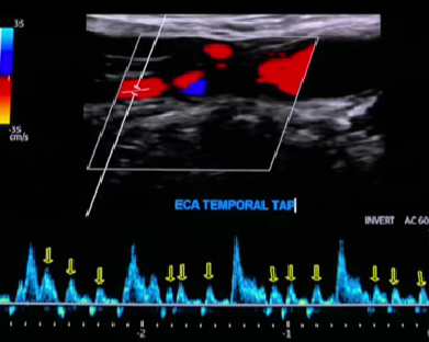 ECA TEMPORAL TAP 문구와 함께 진동이 관찰되는 도플러 파형