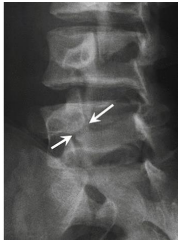 요추 사위상(Oblique view)에서 pars interarticularis의 결손이 관찰되는 X-ray 영상