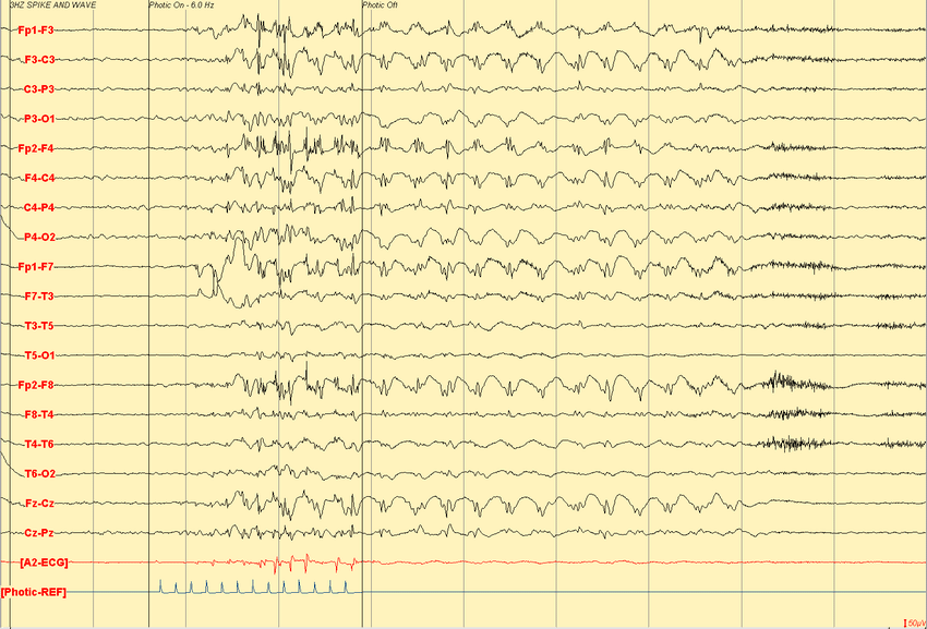 EEG showing Photoparoxysmal Response