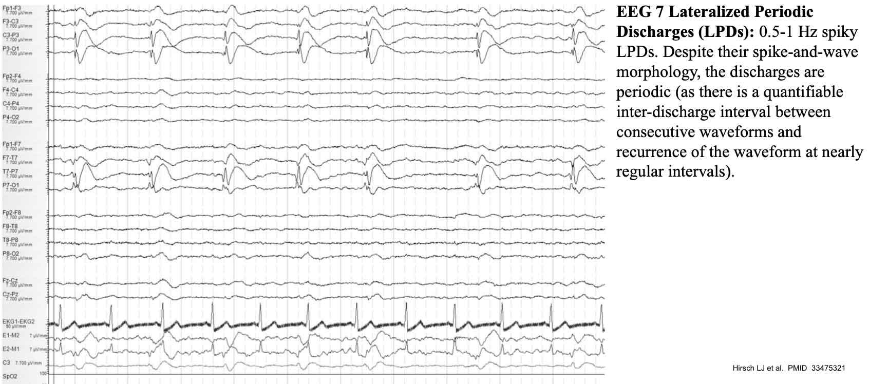 EEG showing Lateralized Periodic Discharges (LPDs)