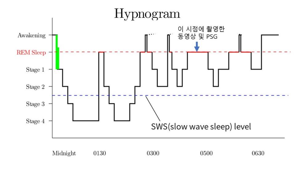 REM 수면 단계에서 이벤트 발생을 보여주는 Hypnogram