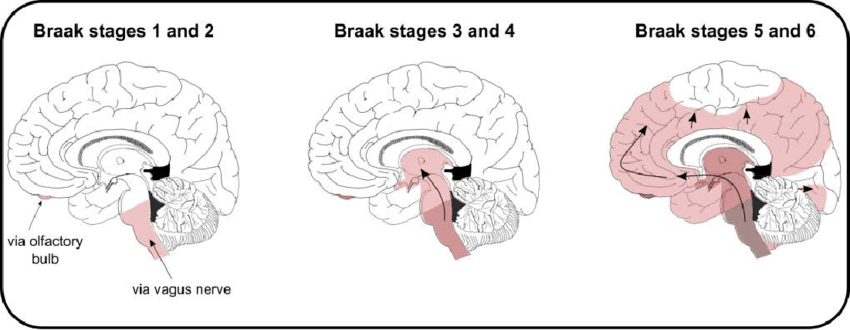 Braak stages of Parkinson's disease