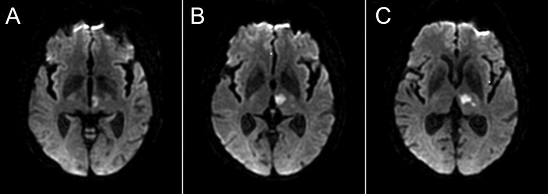 뇌 MRI DWI: 좌측 시상 부위의 고신호강도 병변(급성 뇌경색)