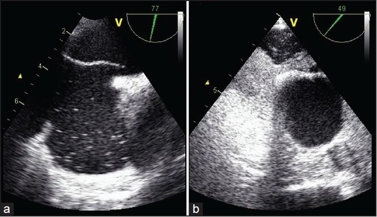 심박동 주기와 기포 유입 시점 그래프