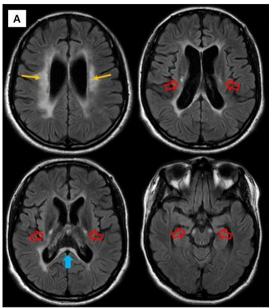 뇌 MRI FLAIR 영상