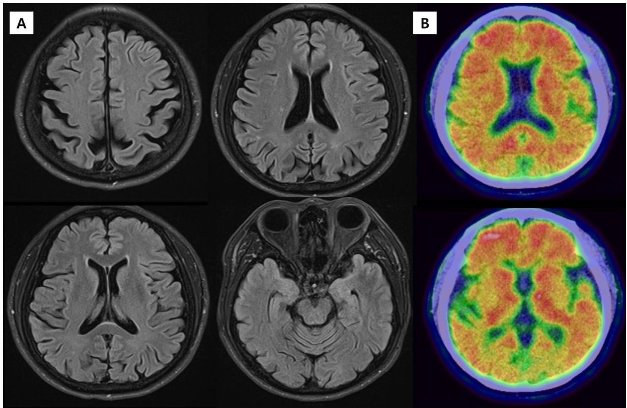 뇌 MRI 및 Amyloid PET