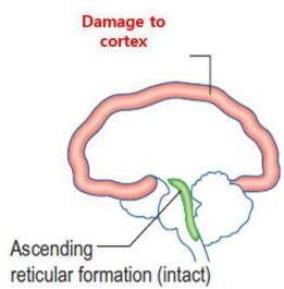 Cortex damage