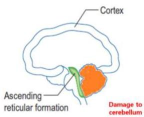 Cerebellum damage