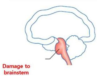 Brainstem damage