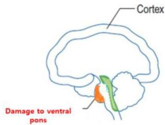 Ventral pons damage