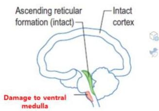 Ventral medulla damage