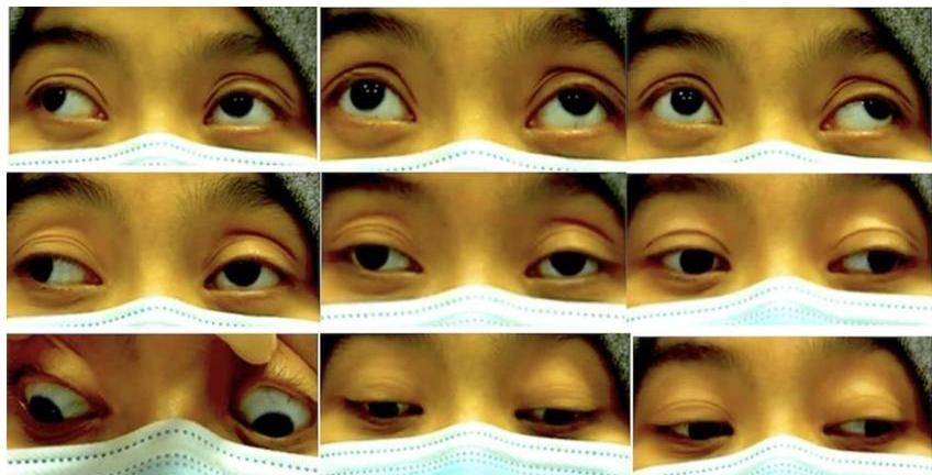 Nine-gaze photo