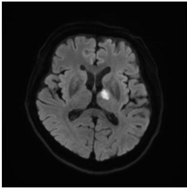 뇌 MRI DWI 축상면 영상에서 좌측 시상 전측부에 국소적인 고신호강도 병변이 보임.