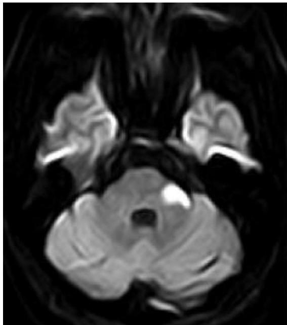 뇌 MRI DWI