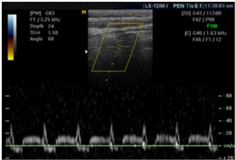 Vertebral artery Doppler ultrasound showing a 'bunny peak' waveform with mid-systolic deceleration.
