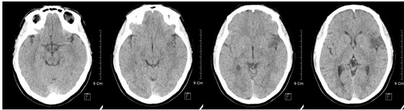뇌 CT - Basal ganglia level