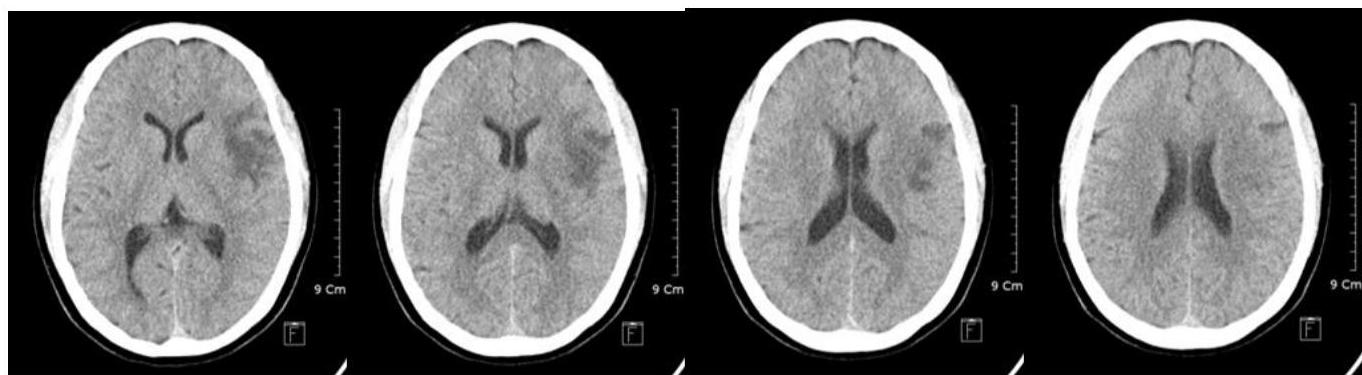 뇌 CT - Supraganglionic level 1