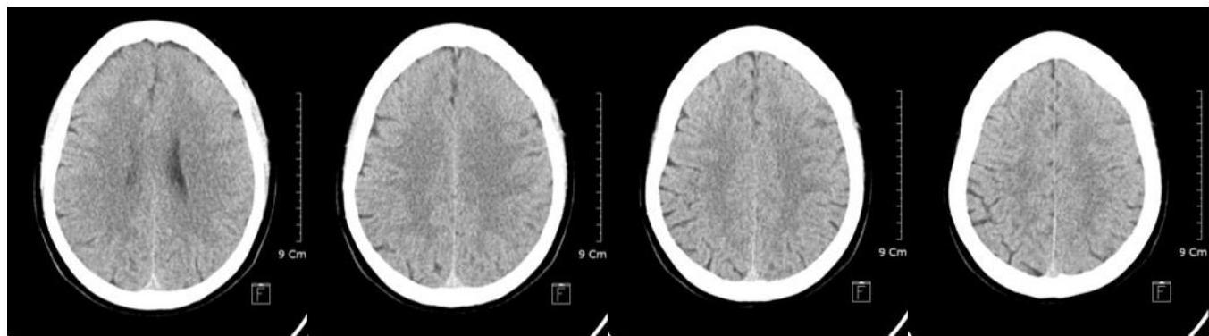 뇌 CT - Supraganglionic level 2
