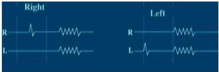 Blink reflex test result