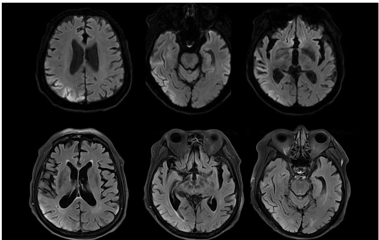 뇌 MRI(DWI 및 FLAIR)