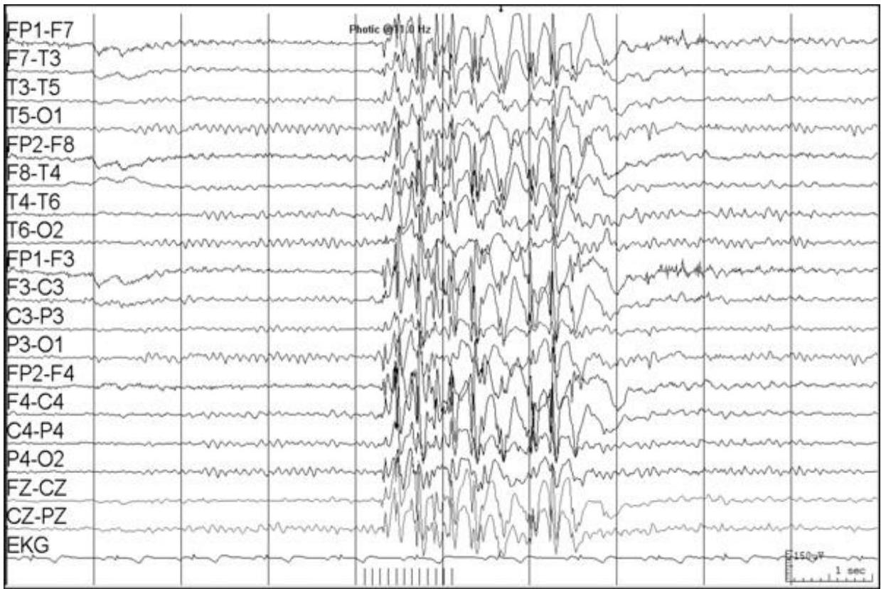 EEG showing generalized spike-and-wave discharges