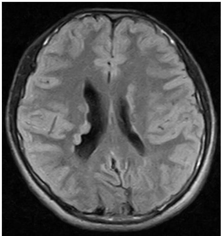 Brain MRI FLAIR axial view showing multiple hyperintense subependymal nodules along the lateral ventricles and cortical tubers in the cerebral parenchyma, characteristic of Tuberous Sclerosis.