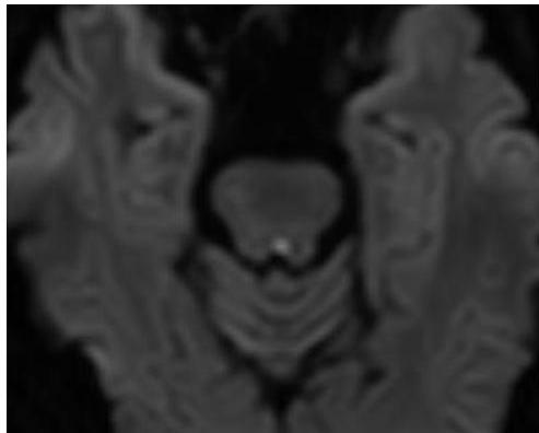 MRI-DWI-2