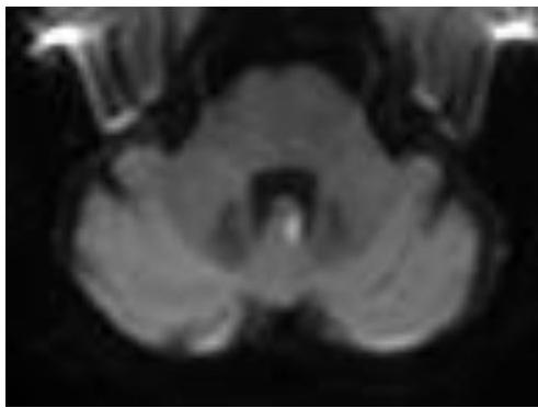 MRI-DWI-3