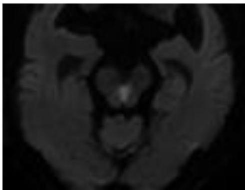 MRI-DWI-4