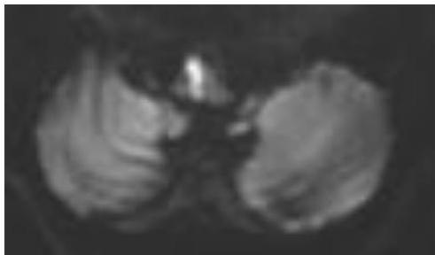 MRI-DWI-5