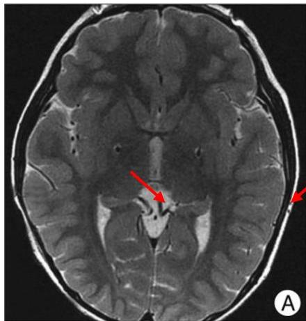 뇌 MRI Axial T2 영상. 기저핵 부위, 특히 내측 창백핵(GPi) 부근에 전극에 의한 artifact와 위치가 관찰됨.