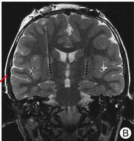 뇌 MRI Coronal T2 영상. 양측 대뇌 반구를 관통하여 기저핵의 내측 창백핵(GPi) 부위에 전극 팁이 위치한 것이 명확하게 보임.